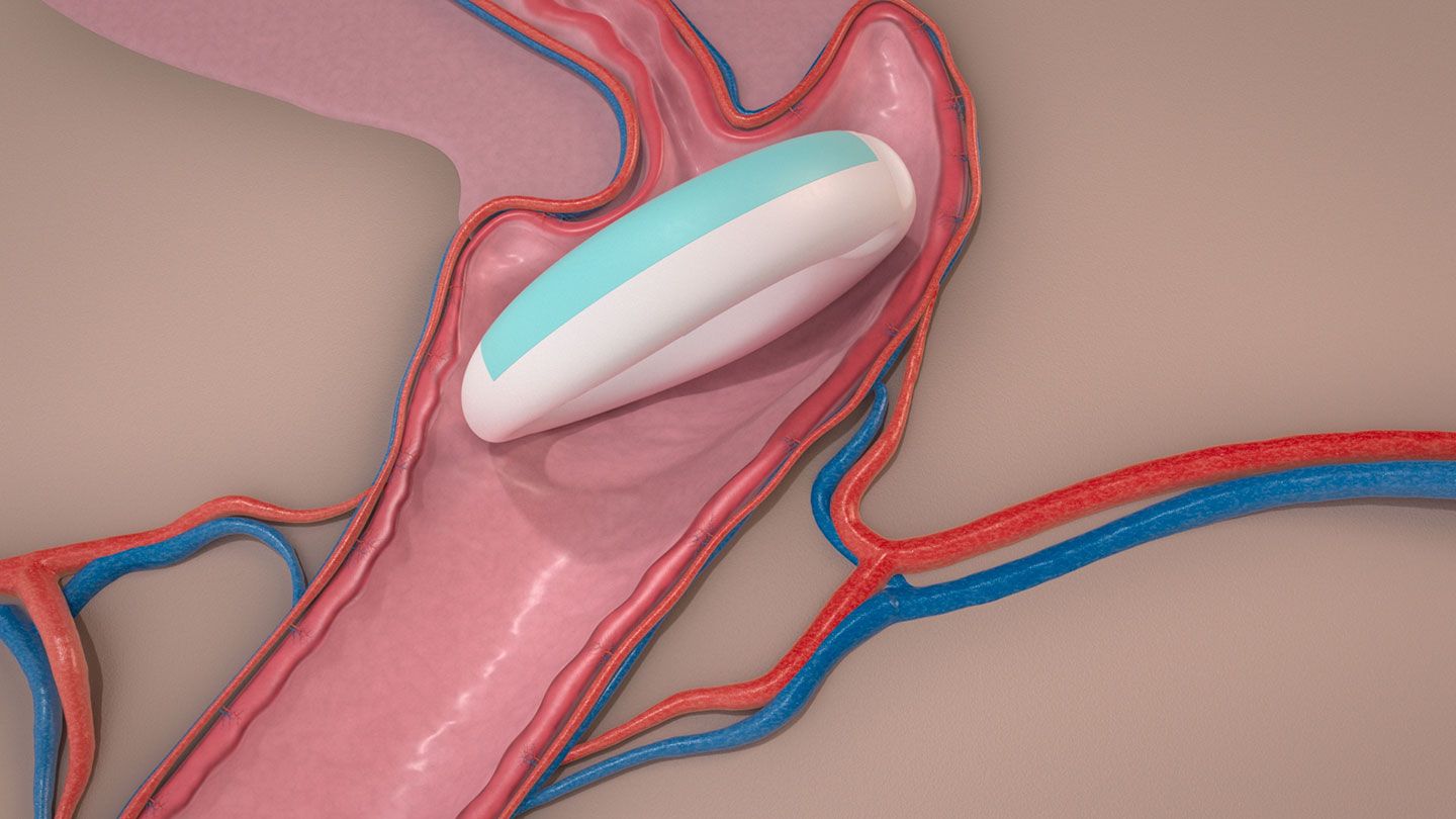 MedRing inside body - resized